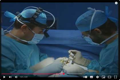 Περίπτωση αύξησης στήθους με την τεχνική Subfascial